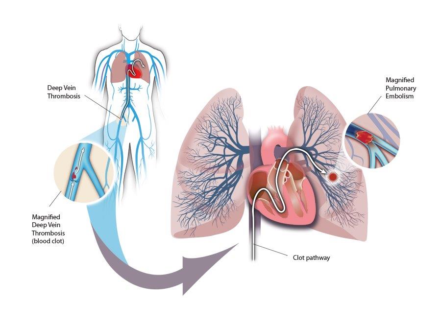 Deep Vein Thrombosis, Symptoms and Causes