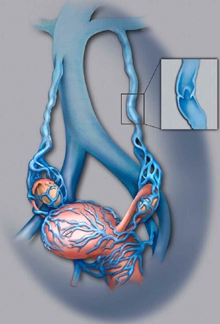 What is Pelvic Venous Congestion Syndrome? (Failures Observed in  Ovarian/Testicular Veins) - Turkey Istanbul Medical