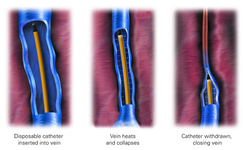 Endovenous Therapy  Center for Vein Care