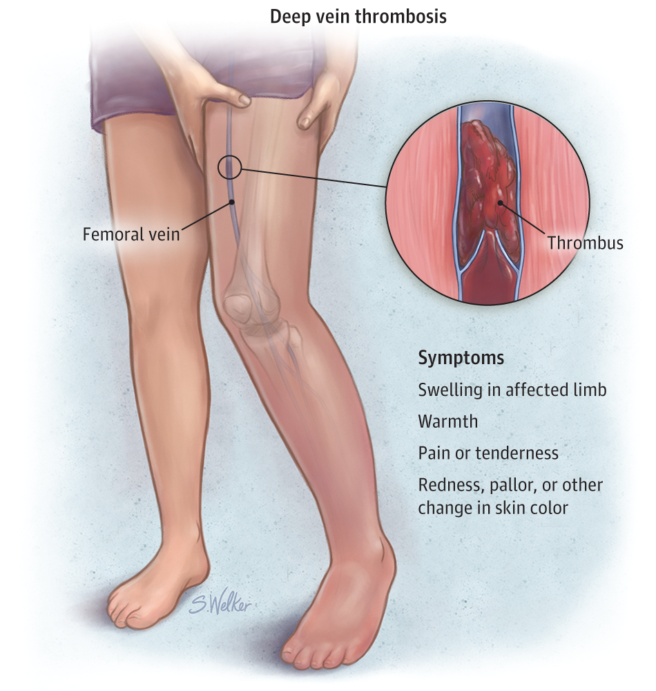 Risk Factors and Complications from Blood Clots