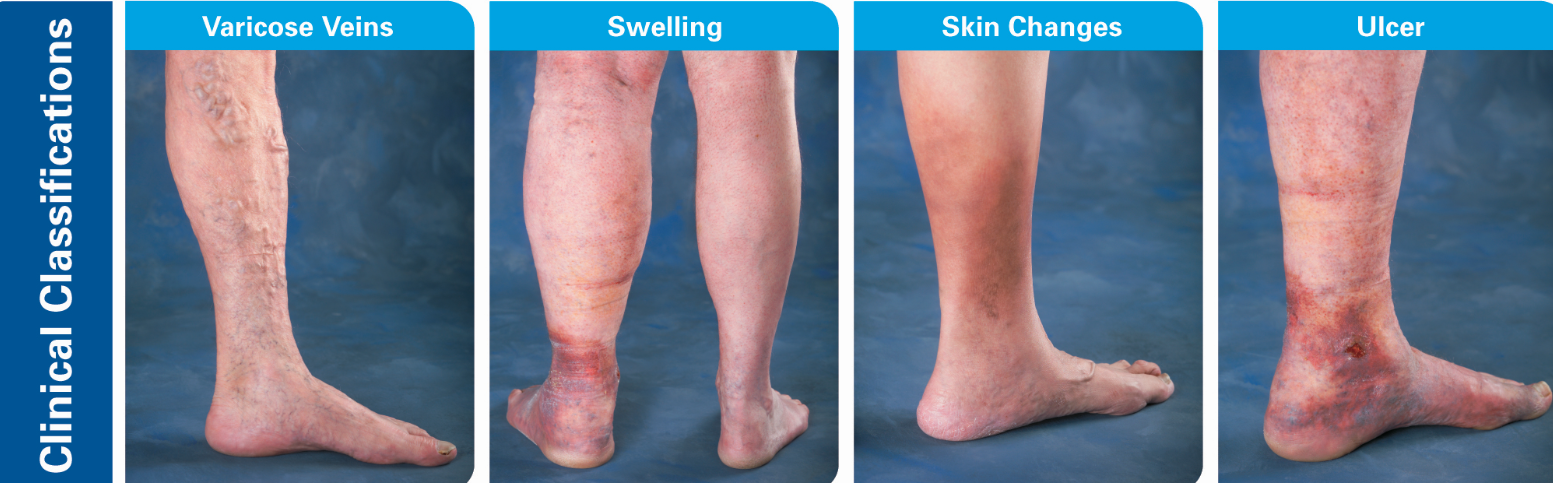 Are Varicose Veins Worse Than Spider Veins? 